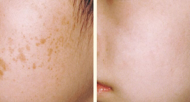 mejor-tratamiento-manchas-cara-despues.jpg mejor tratamiento manchas cara despues