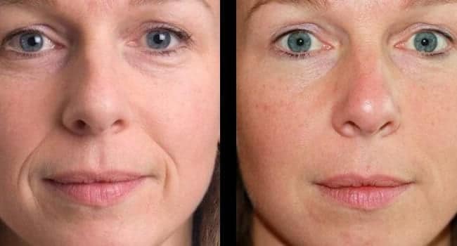 rejuvenecer-rostro-40-años.jpg rejuvenecer rostro 40 años