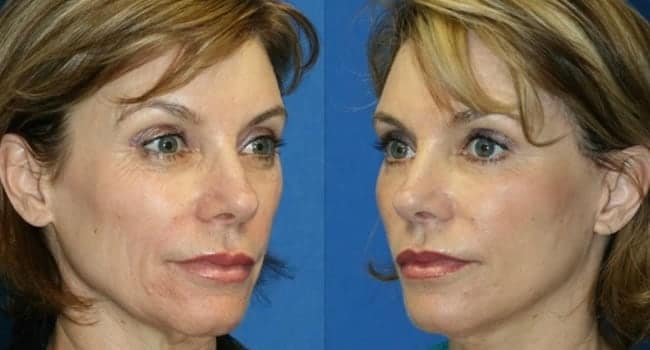 rejuvenecimiento-facial-malaga.jpg rejuvenecimiento facial malaga