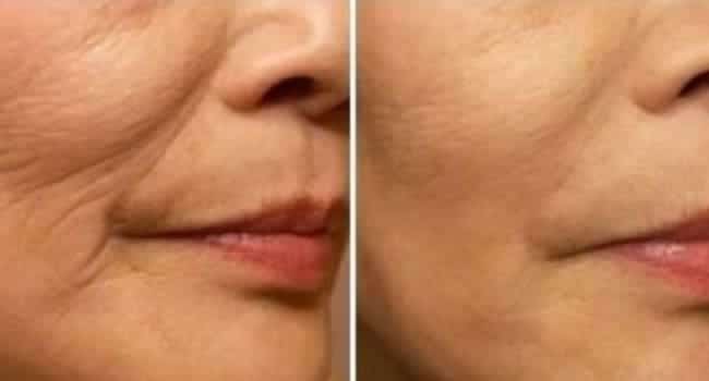 rejuvenecimiento-facial-opiniones.jpg rejuvenecimiento facial opiniones