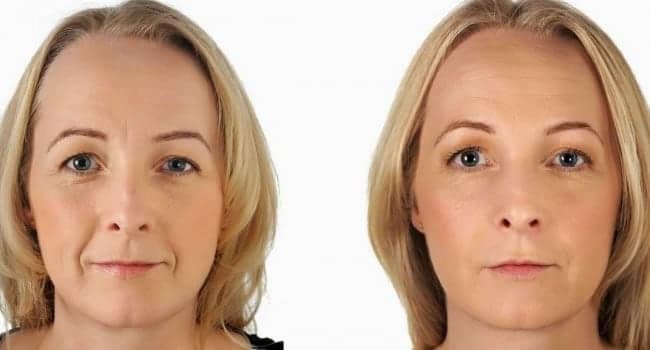 rejuvenecimiento-facial-precios.jpg rejuvenecimiento facial precios