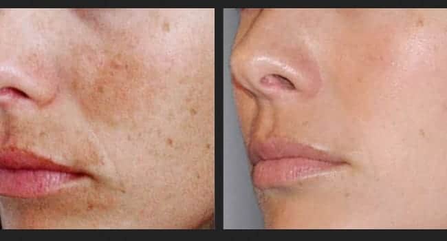 tratamiento-antimanchas-facial-opiniones-antes-y-despues.jpg tratamiento antimanchas facial opiniones antes y despues
