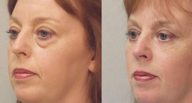 drenaje-linfatico-facial-bolsas-ojos.jpg drenaje linfatico facial bolsas ojos