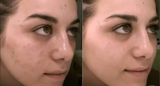 exfoliante-microdermoabrasion.jpg exfoliante microdermoabrasion