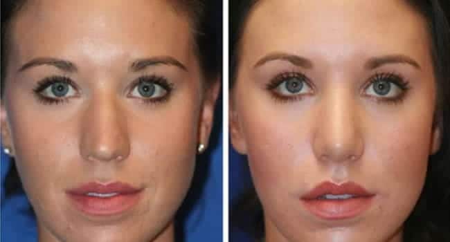 microdermoabrasion-para-acne.jpg microdermoabrasion para acne