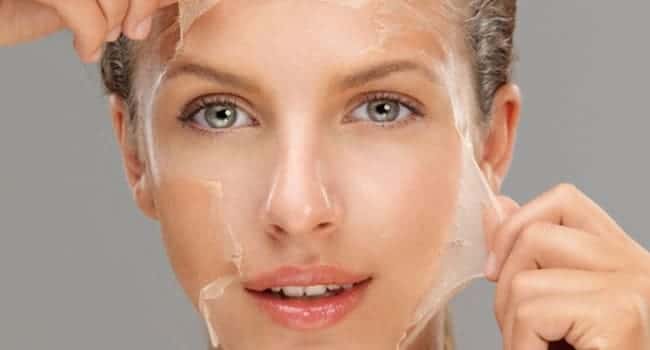 peeling-acne.jpg peeling acne
