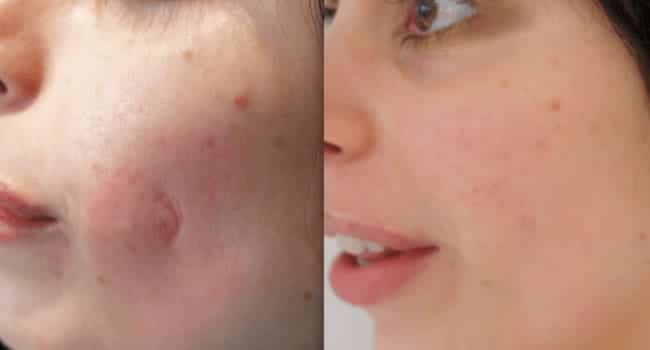 peeling-precio-antes.jpg peeling precio antes