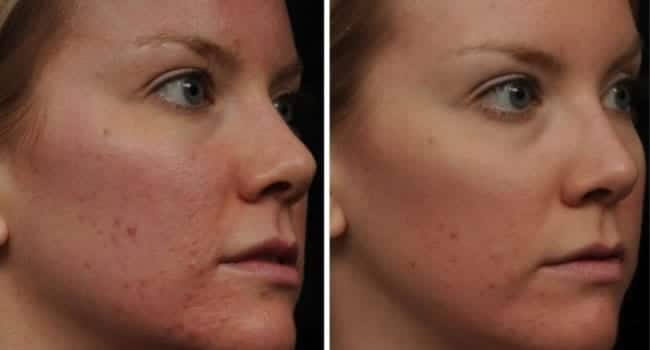 tipos-de-peeling-facial.jpg tipos de peeling facial