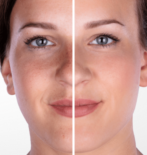 Microdermoabrasion en Málaga - Precio y Calidad en BLUSH Estética